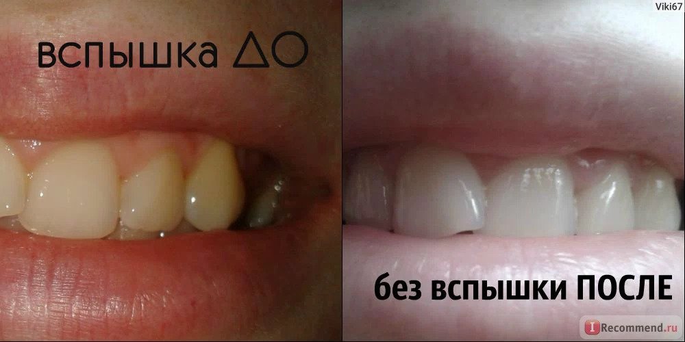 Отбеливание зубов дома, фото до и после
