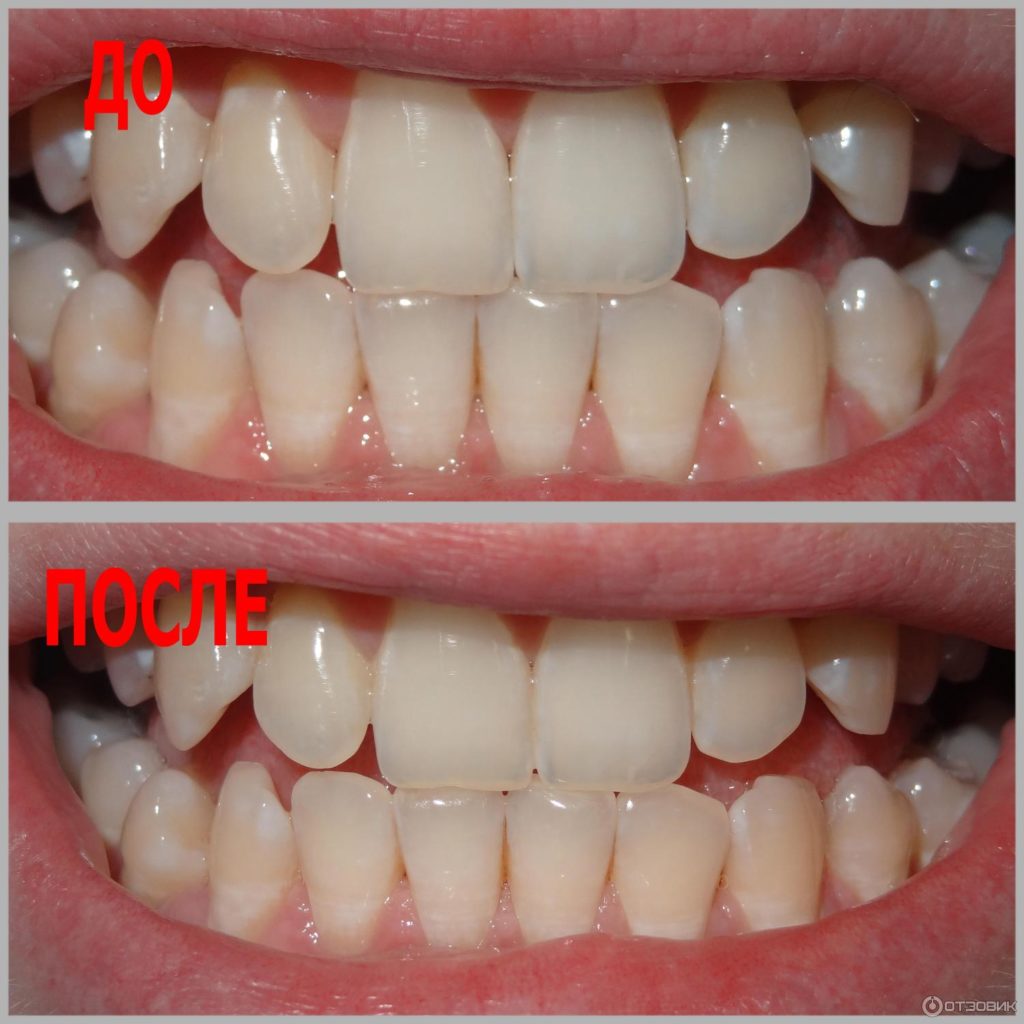 Отбеливание зубов в домашних условиях, фото до и после