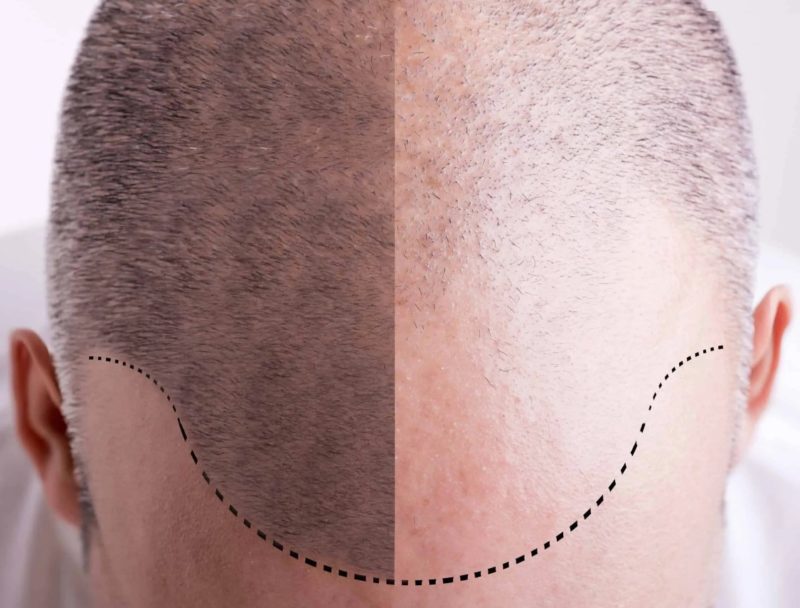 трихопигментация волос на голове у мужчины фото