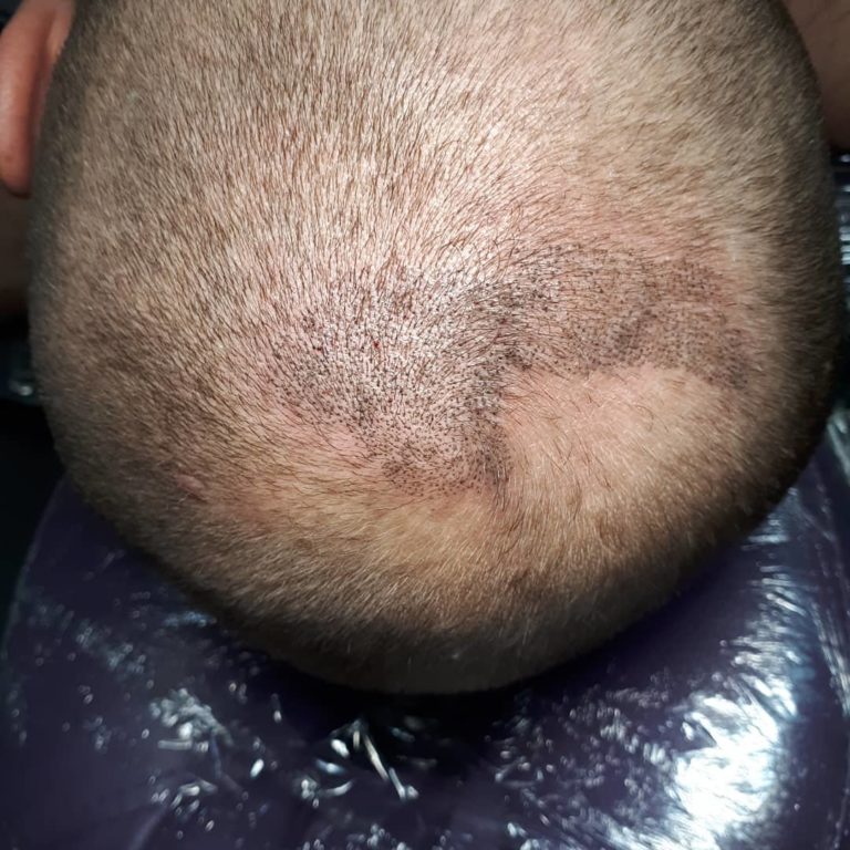 Татуаж головы с имитацией волос замаскирует лысины у мужчин и женщин